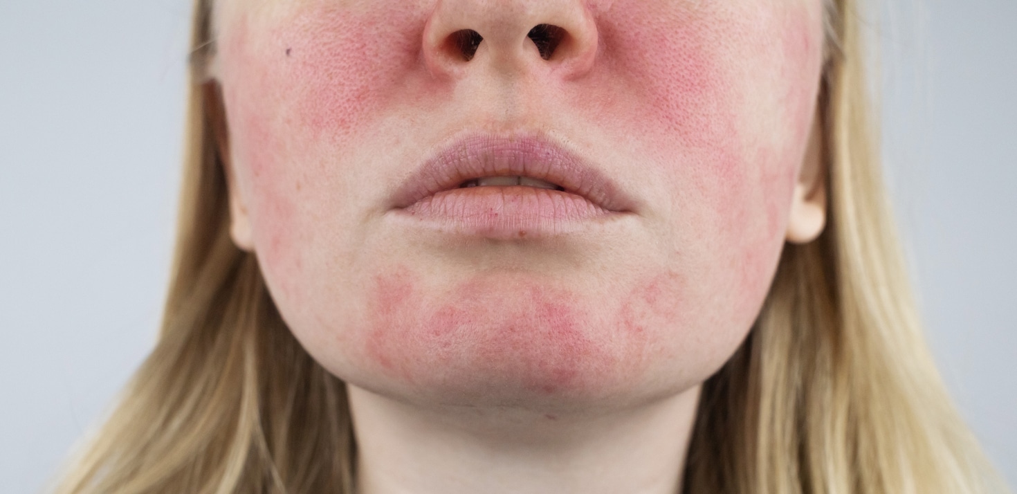 Closeup of a woman with rosacea on her face.