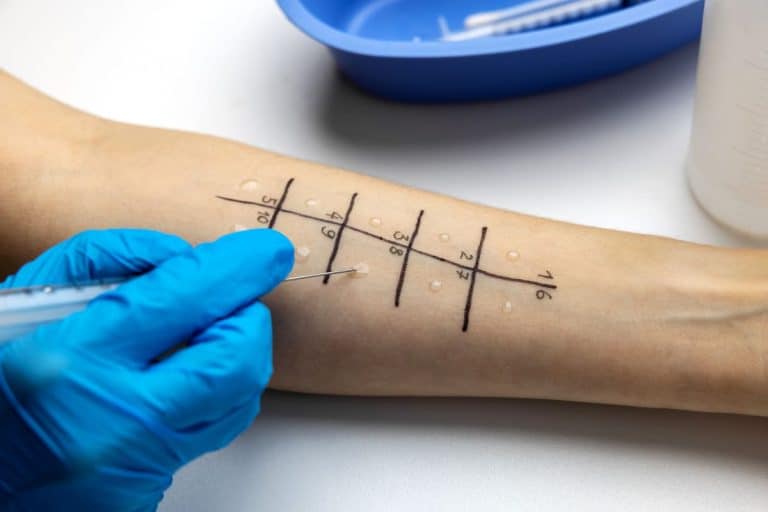 The arm of a patient receiving an allergy test. There is a numbered grid with dots of liquid on it and a gloved hand adding further drops using a syringe.